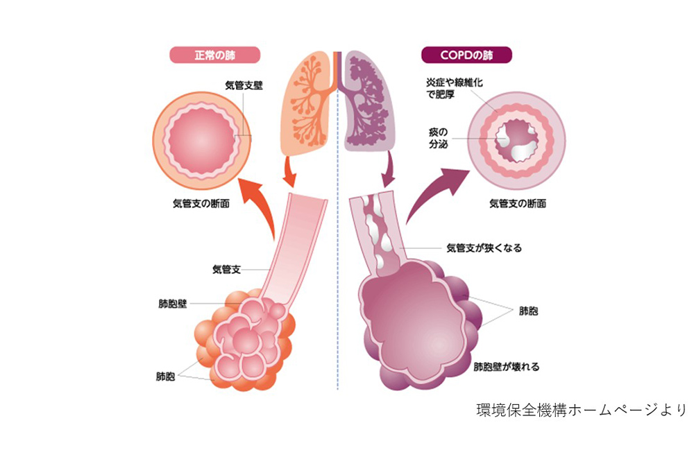 医療画像における COPD と健康な肺の比較